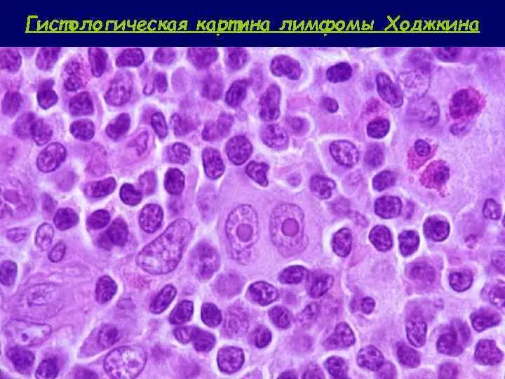Лейкозы лимфогранулематоз. Лимфогранулематоз причины. Лейкозы лимфогранулематоз. Лимфогранулематоз лимфатического узла микропрепарат описание. Неходжкинская лимфома патанатомия.