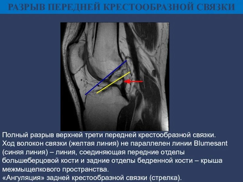 Где находится разрыв. Субтотальный разрыв передней крестообразной связки коленного. передняя крестообразная связка разрыв. мрт коленного сустава разрыв задней крестообразной связки. симптомы повреждения передней крестообразной связки.