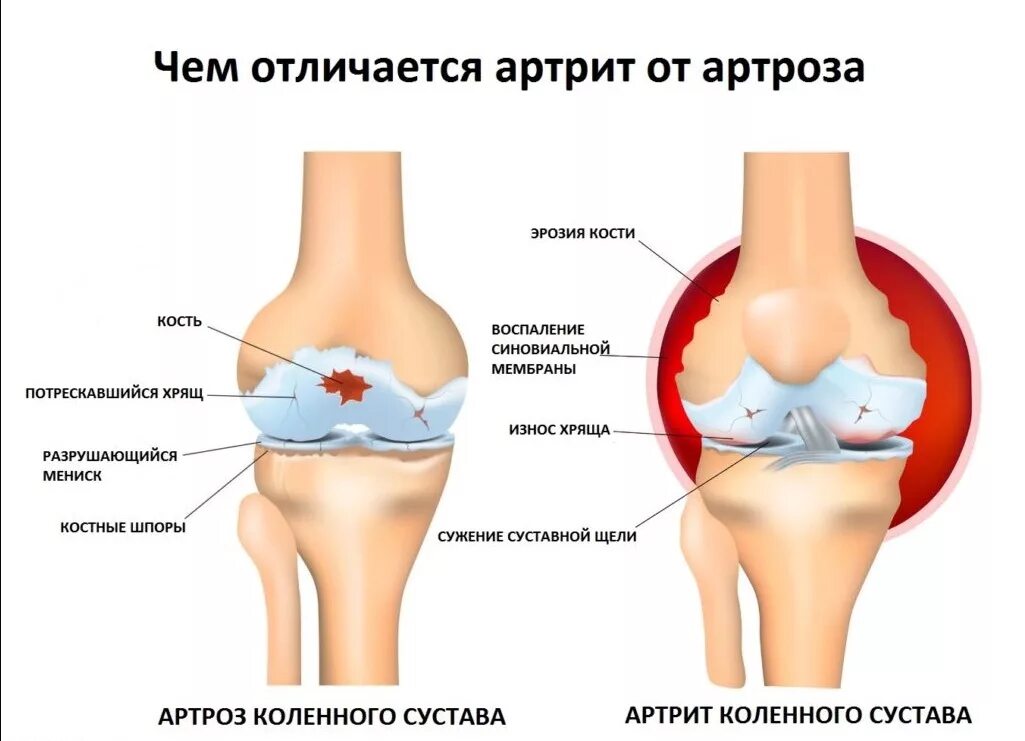 Какие бывают болезни суставов. Артрит или артроз коленного сустава отличия. Артрит остеоартрит артроз. Ревматоидный артрит и артроз. Артрит коленного сустава схема.