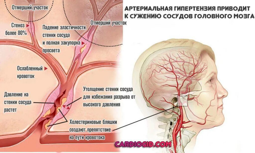 Сужение сосудов симптомы причины. Сужение сосудов головного мозга. Расширение артерий головного мозга. Артерии и сосуды головного мозга.