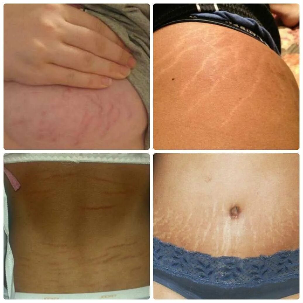 Что делать если образовались после. Псевдофолликулит вросшие. Растяжки после беременности. Степени ожогов 2 степень. Лазерная наноперфорация от растяжек.