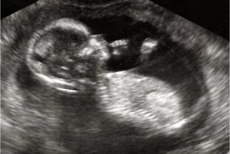 узи 12 недель беременности. скрининг 3 месяца. пол ребёнка в 12 недель на узи. узи 3 месяца беременности. скрининг 3 месяца.