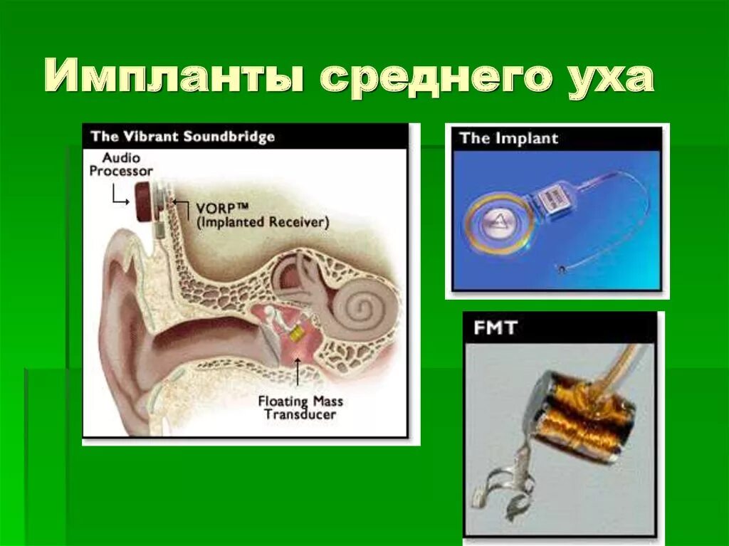 Операция на среднем ухе. Имплантация среднего уха. Электронные импланты среднего уха.