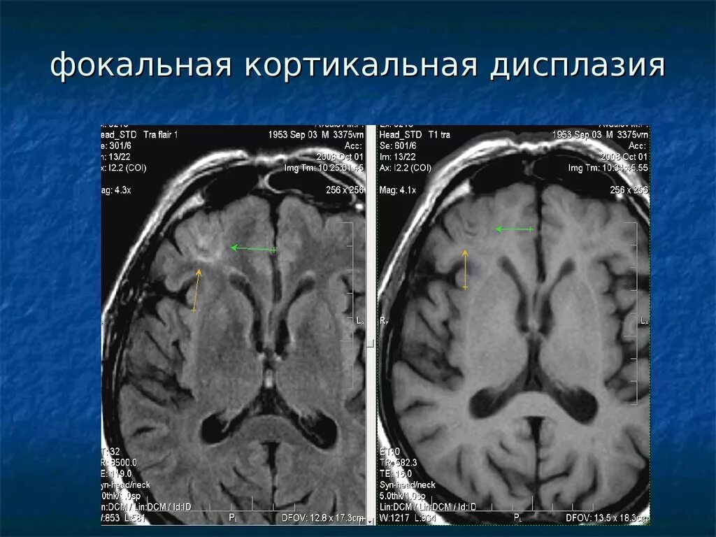 Фокальная кортикальная дисплазия мрт. ФКД головного мозга мрт. ФКД дисплазия. Фокальная корковая дисплазия мрт. Корковые изменения головного мозга