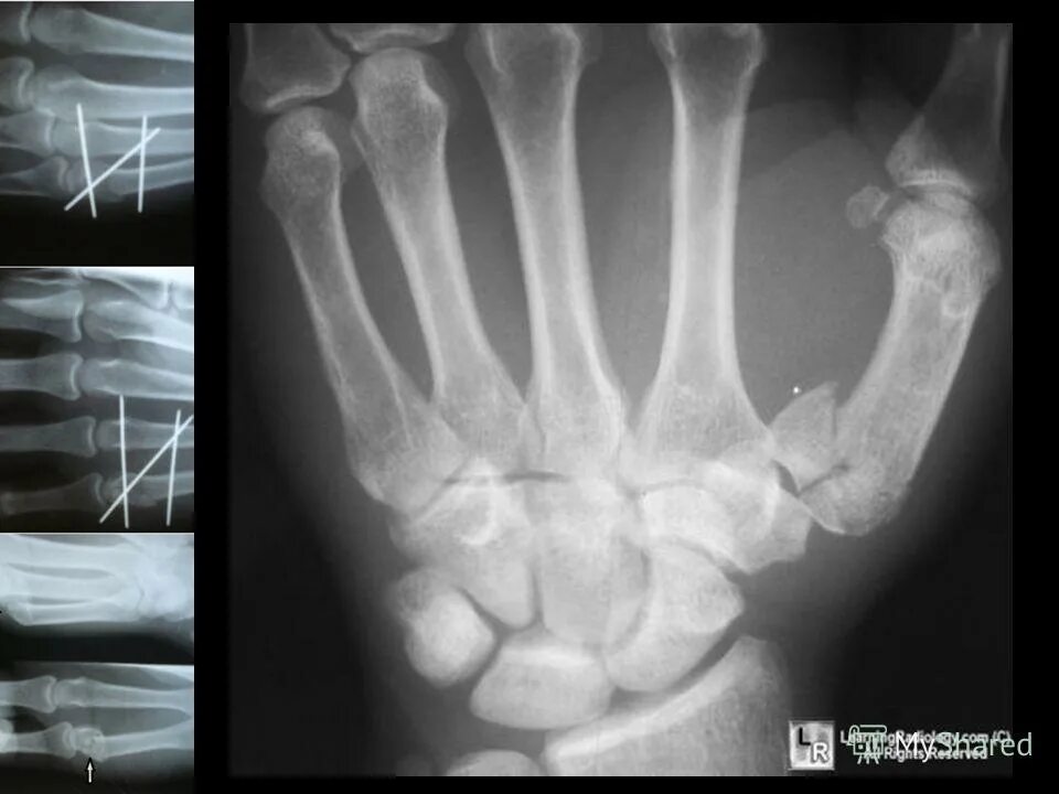 Перелом беннета со смещением. Как разработать пястную кость после перелома. Перелом 5 пястной кости со смещением. Спица киршнера перелом 5 пястной кости. Остеосинтез 5 пястной кости.