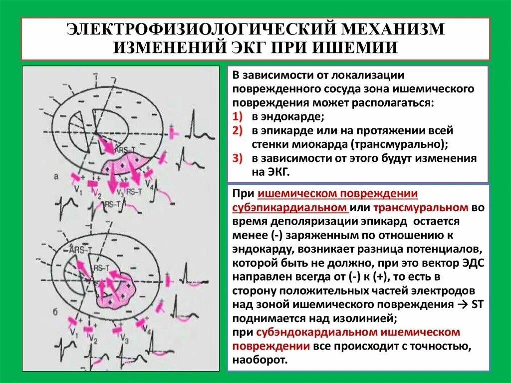 Критерии ишемии. Критерии ишемии миокарда на ЭКГ. ЭКГ критерии ишемии и повреждение. Ишемическое повреждение миокарда на ЭКГ. Ишемия миокарда на ЭКГ.