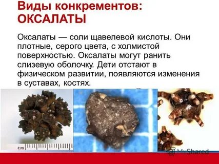 Диета при оксалатных камнях