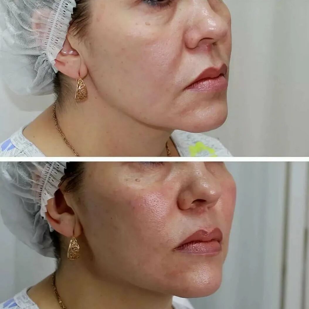 Контурная пластика. Инекционное косметология. Как делают контурную пластику. Контурная пластика препаратом radiesse. Ювидерм волюма в скулы.