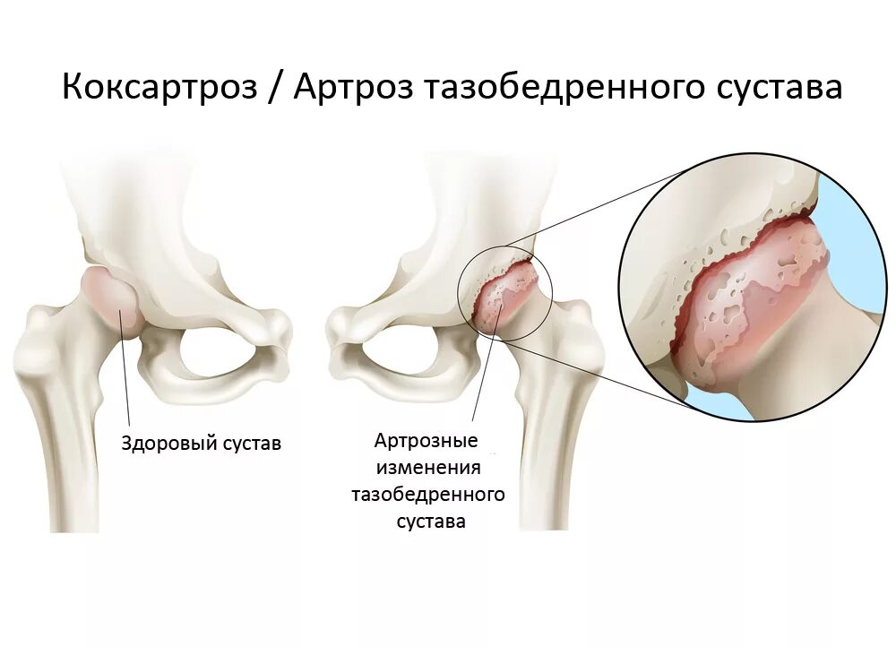 Тазобедренный сустав 3 степени лечение. Деформирующий остеоартроз тазобедренного сустава ii степени. артроз 2-3 степени тазобедренного сустава. коксо артроз бедренного сустава симптомы. артроз тазобедренного сустава 2-3 степени симптомы.