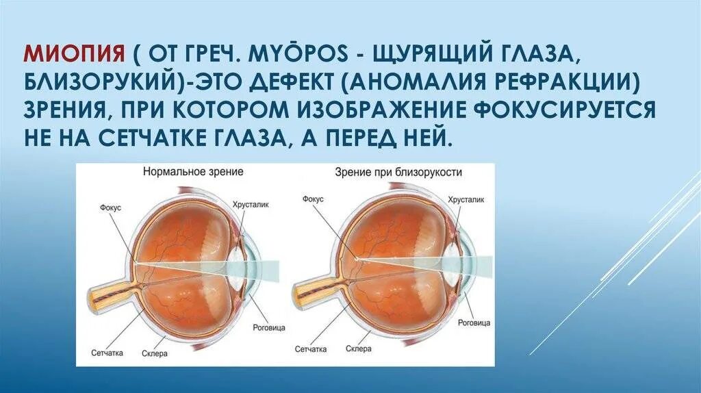 Миопия глаза высокой степени. Дальнозоркость и близорукость строение глаза. Миопия гиперметропия астигматизм. Строение глаза при дальнозоркости. Патология рефракции гиперметропия.