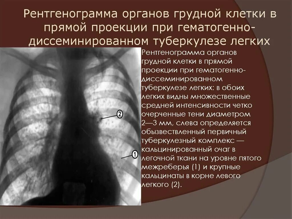 Туберкулез молочной. Диссеминированный туберкулез рентген описание. Рентгенография грудной клетки при диссеминированный туберкулез. Флюорография органов грудной клетки туберкулез. Описание рентгена ОГК при туберкулезе.