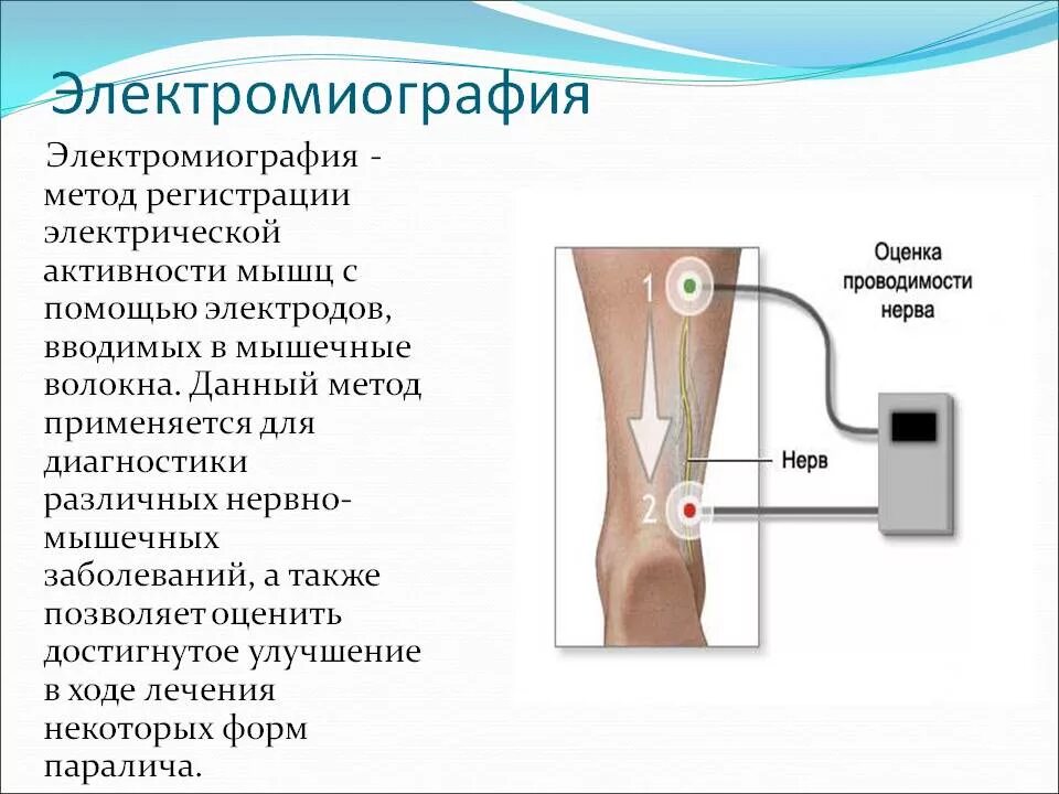 Ссылка на источник https mrtpetrograd ru. Стимуляционная (поверхностная) электромиография. Электромиография схема электродов. Электронейромиография методика. Электромиография (ЭМГ).