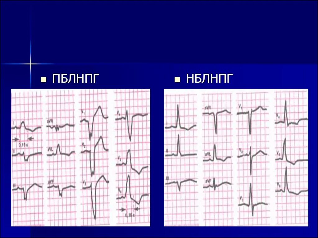 Блокада ножки гиса симптомы. Блокада левой ножки пучка Гиса на ЭКГ. Блокада ЛНПГ на ЭКГ. ЭКГ критерии блокады левой ножки пучка Гиса. ЭКГ при блокаде левой ножки пучка Гиса.