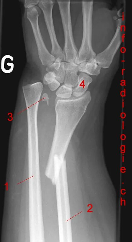Перелом шиловидного отростка лучевой кости. Перелом лучезапястного сустава в типичном месте рентген. Шиловидный отросток левой лучевой кости. Лучевой отросток лучевой кости.