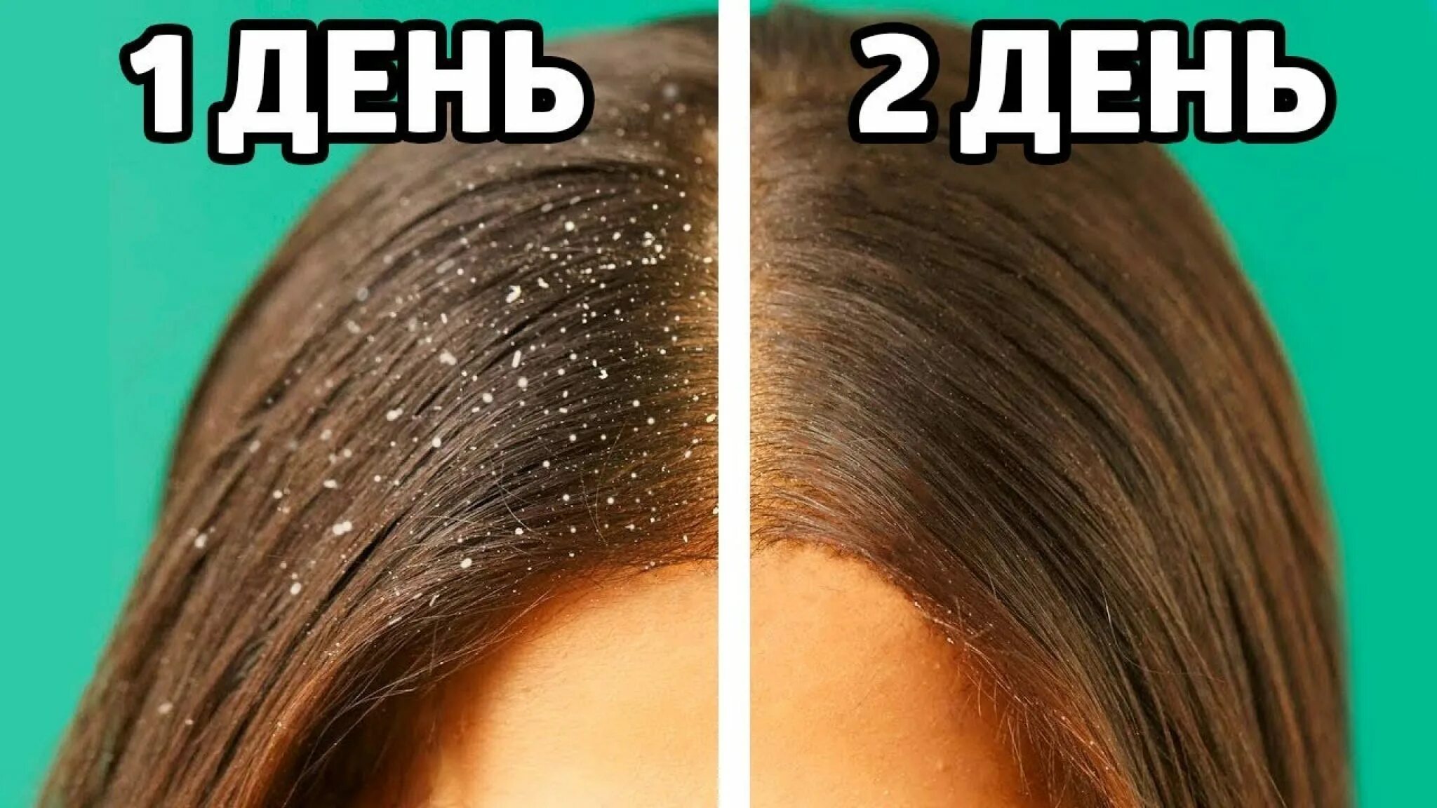 Как избавиться от перхоти навсегда. Методы избавления от перхоти. избавление от перхоти навсегда.