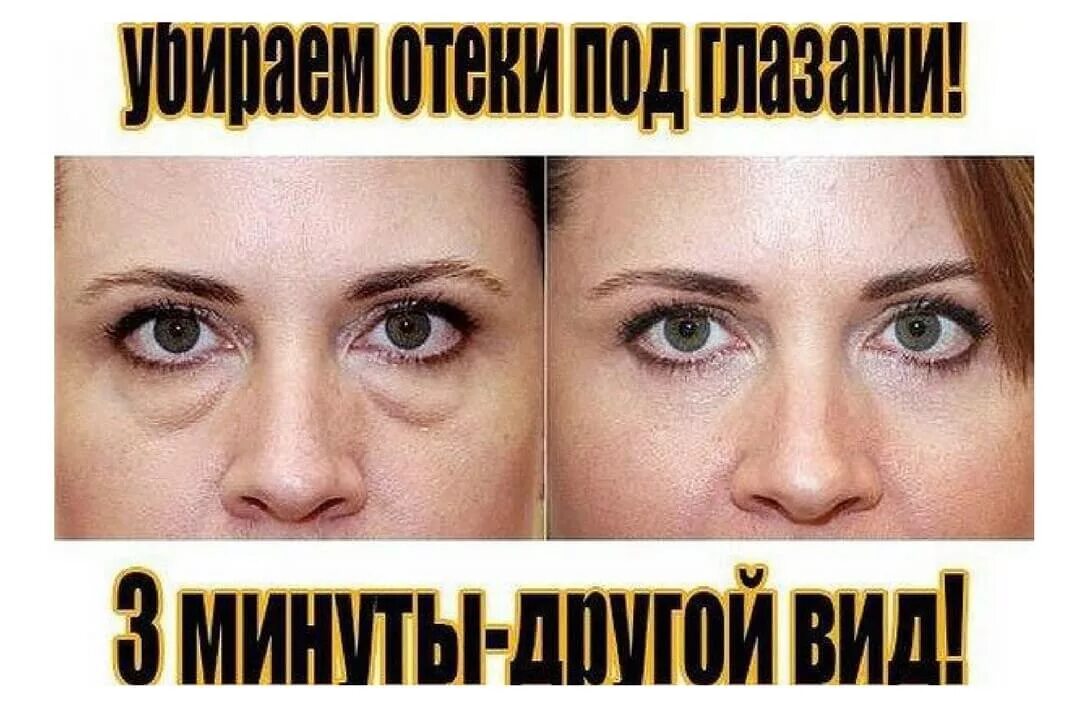Как утром быстро убрать отек. Убирание отеков под глазами. Избавление от мешков под глазами. Убрать мешки под глазами быстро. Отечность и мешки под глазами.