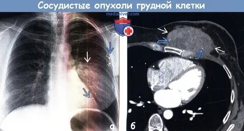 Рак грудной клетки