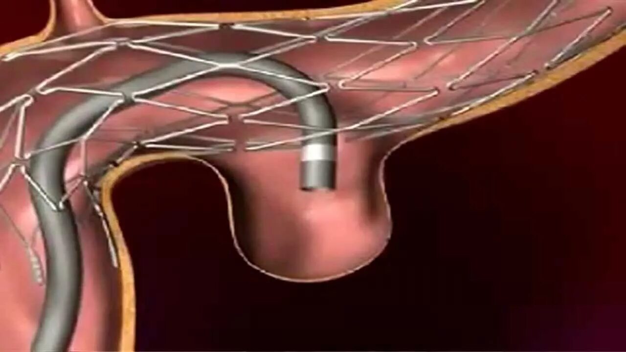 Стентирование видео. Эндоваскулярная операция аневризмы головного. Стентирование сосудов сонной артерии. Эндоваскулярная эмболизация. Эндоваскулярная эмболизация сосудов.