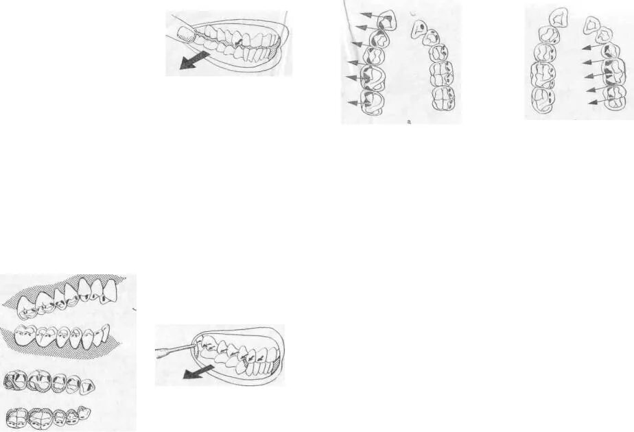 Техника наложения окклюзионной