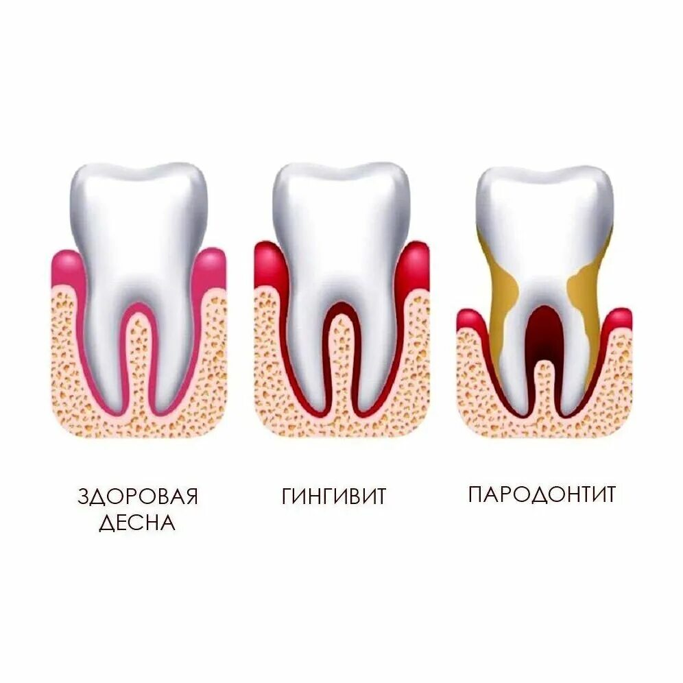 Лечение заболевшего зуба. Десквамативный гингивит. Воспаление десен пародонтит. Заболевание гингивит пародонтит. Гингивит пародонтит периодонтит.