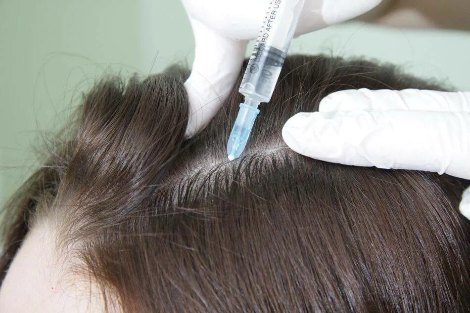 Инъекции головы. Мезо волосистой части головы. Мезотерапия кожи головы Mesoline hair. Плазмотерапия волосистой части головы.