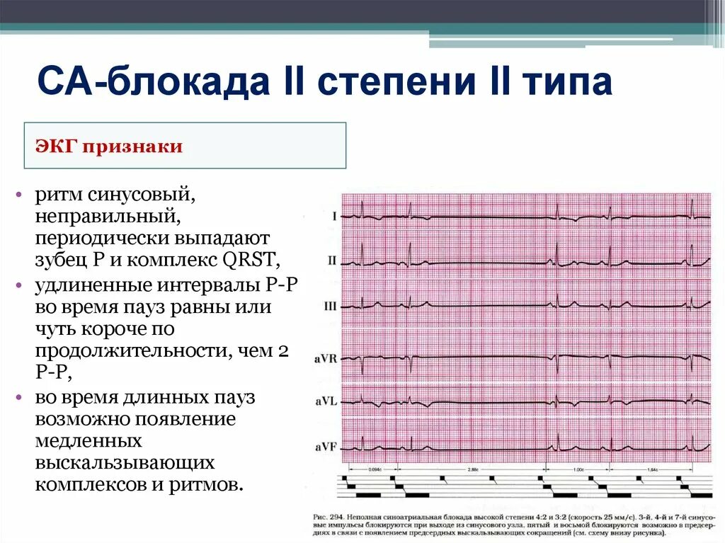 Са блокада 1 степени. ЭКГ при синоатриальной блокаде 2 степени Тип 1. Синоатриальная блокада Мобитц 1 ЭКГ. Са блокада 2 степени 1 типа на ЭКГ. Са блокада 1 степени на ЭКГ признаки.