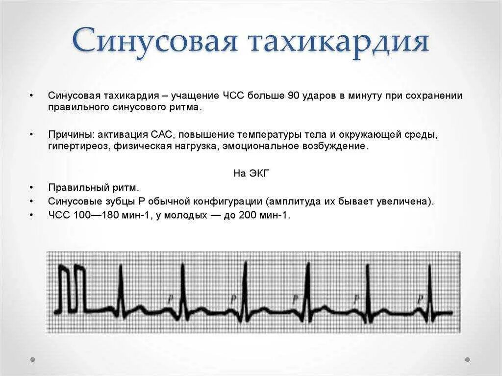 Аритмия при нормальном давлении и пульсе. Экг при синусовой тахикардии сердца. синусовая тахиаритмия на экг. синусовая тахикардия экг признаки. клинические симптомы тахикардии.