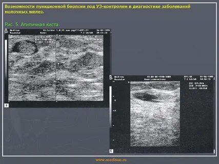 Как часто надо делать узи молочной железы