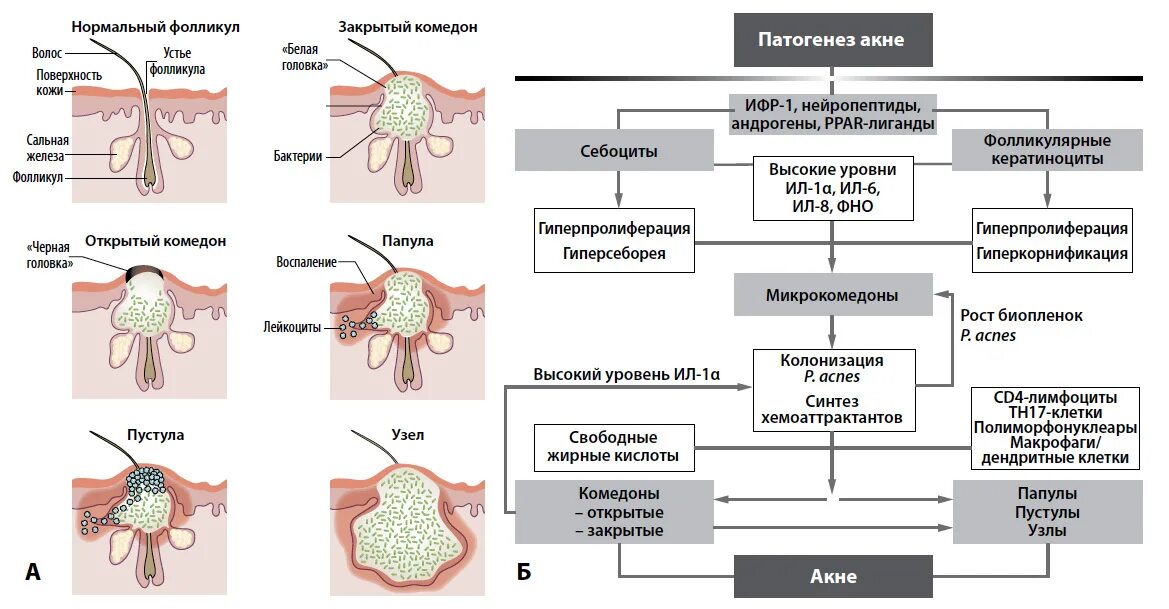 Патогенез угревой болезни схема. Механизм развития угревой сыпи. Механизм формирования акне. Патогенез вульгарных угрей. 17 фолликулам