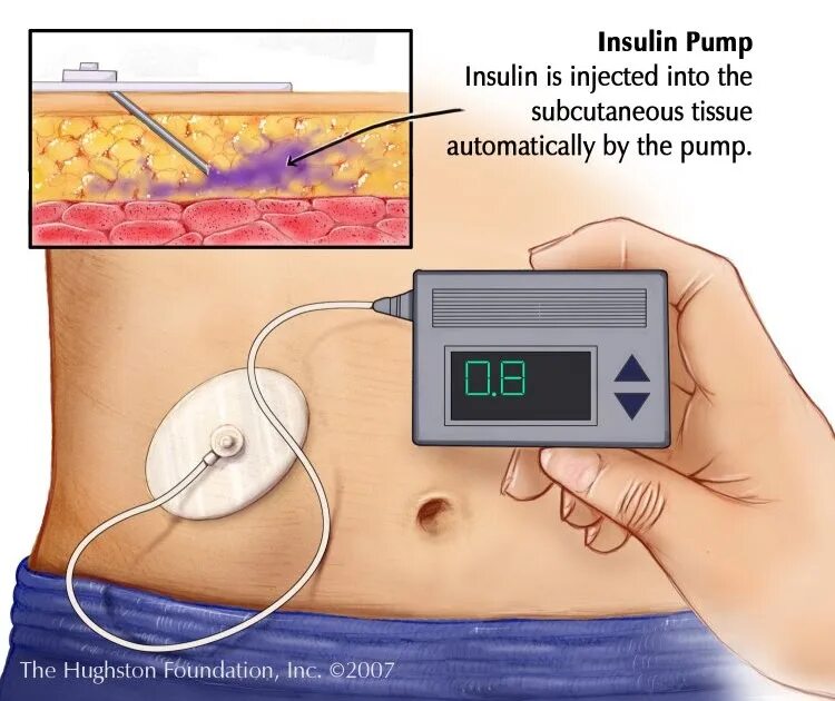 Инсулиновая помпа для диабетиков 1 типа. Помпа инсулиновая с системой постоянного мониторирования Глюкозы. Инсулиновая помпа сахарном диабете у детей. Помпа инсулиновая для детей диабетиков 1.