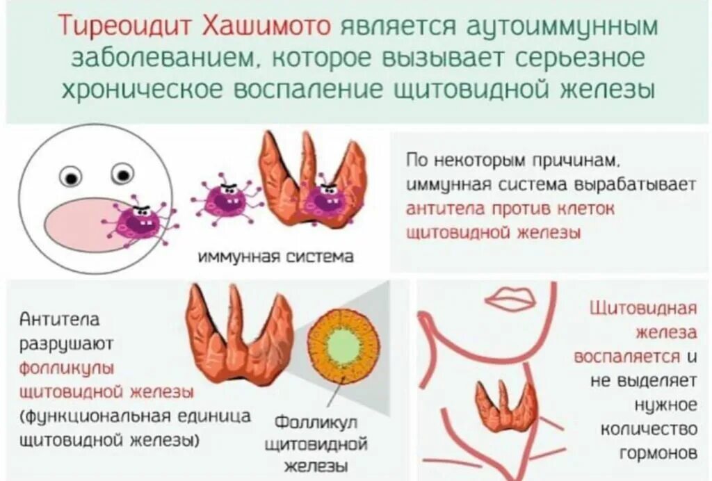 Аутоиммунный зоб. Аутоиммунный тиреоидит щитовидной железы что это такое. Хашимото щитовидной железы. Щитовидная железа при болезни Хашимото. Болезнь Хасимото щитовидной железы..