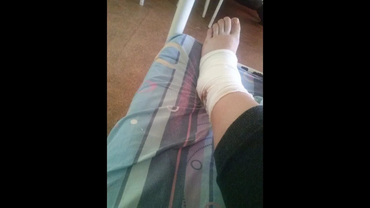 Подсиндесмозный перелом лодыжки. Позиционный винт остеосинтез. Остеотомия weil 2 плюсневой кости. Трехлодыжечный перелом со смещением фото после операции. Перелом лодыжки пронация.