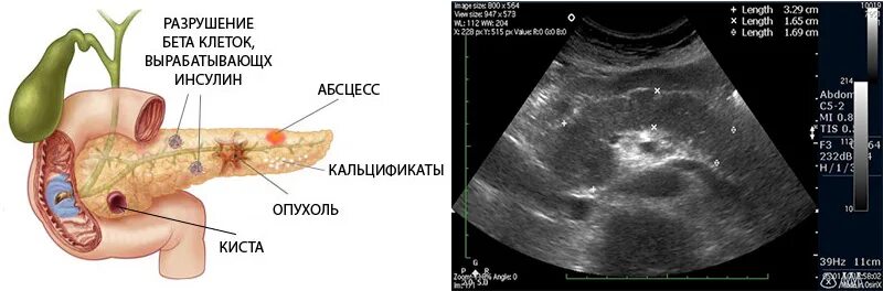 УЗИ брюшной полости поджелудочная железа. Вирсунгов проток поджелудочной железы УЗИ. Патологии поджелудочной железы на УЗИ. УЗИ поджелудочной железы панкреатит.