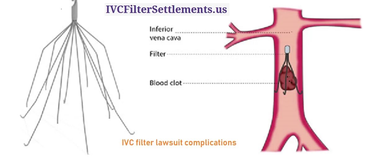 Имплантация кава-фильтра в нижнюю полую Вену. OPTEASE retrievable Vena Cava Filters кава фильтр. Inferior Vena Cava Filter. Кава фильтр в нижней полой Вене. Тромбоз фильтры