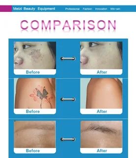 Picosure отзывы удаление