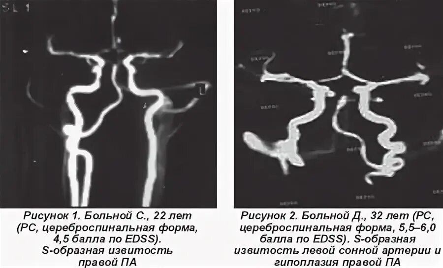 Гипоплазия правой артерии головного мозга. Гипоплазия позвоночной артерии. Гипоплазия позвоночной артерии мрт. Кинкинг позвоночной артерии. Гипоплазия внутренней сонной артерии.