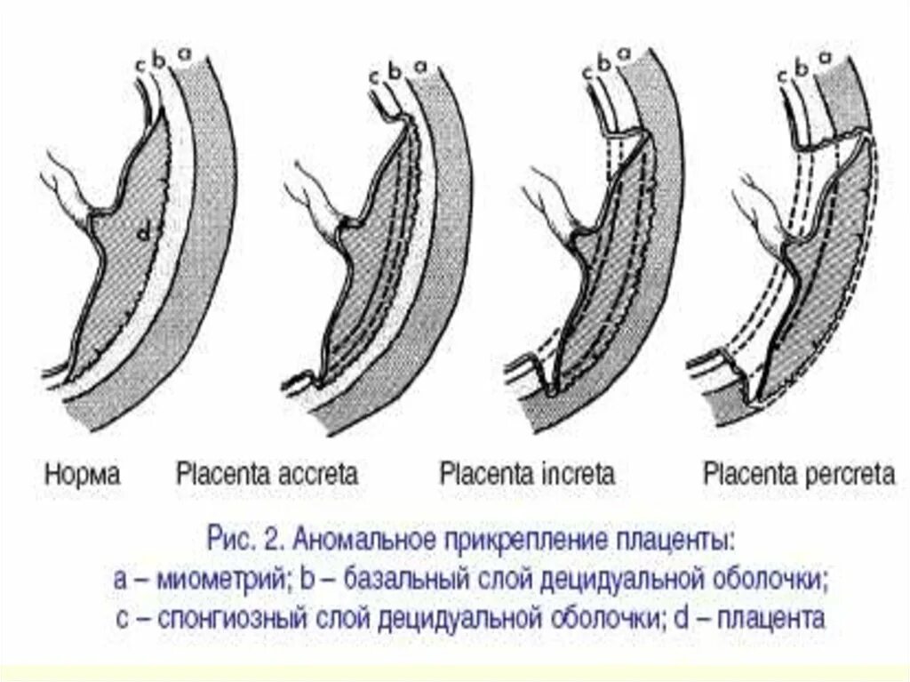 Истинное приращение. Типы прикрепления плаценты. Степени приращения плаценты. Аномальное прикрепление плаценты. Патологическое прикрепление плаценты.