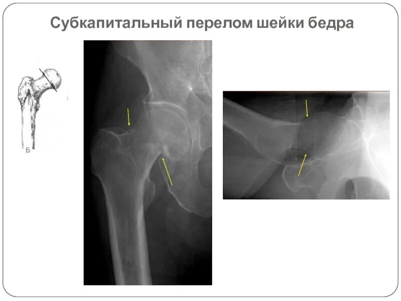 Вколоченный перелом шейки бедренной кости. Вколоченный перелом шейки бедра рентген. Вколоченный перелом шейки бедренной кости рентген. Переломы шейки бедра классификация рентген. Шейка бедра заживает