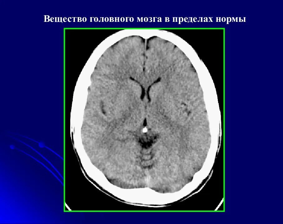 Норма кт. Компьютерная томография головного мозга норма. кт головного мозга норма. нормальная кт анатомия головного мозга. ркт головного мозга.