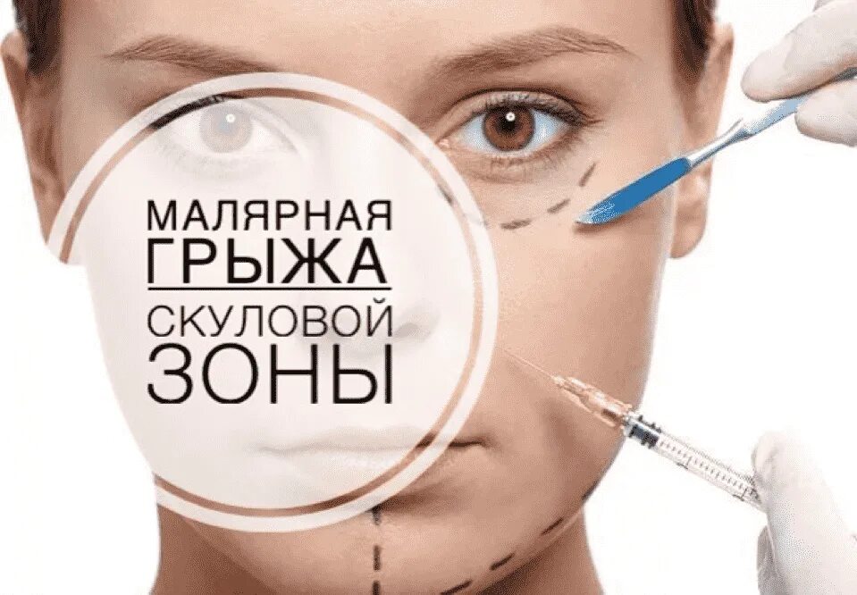 Малярные мешки под глазами лечение. Малярная зона лица это. малярные мешки 100 линий. профессиональная косметика от малярных мешков. косметолог лисин баланс мед эстетик.