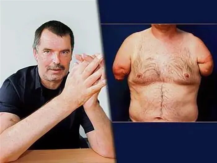 You Have a New Identity.' Patients Share What It’s Like to Recover From a Face T
