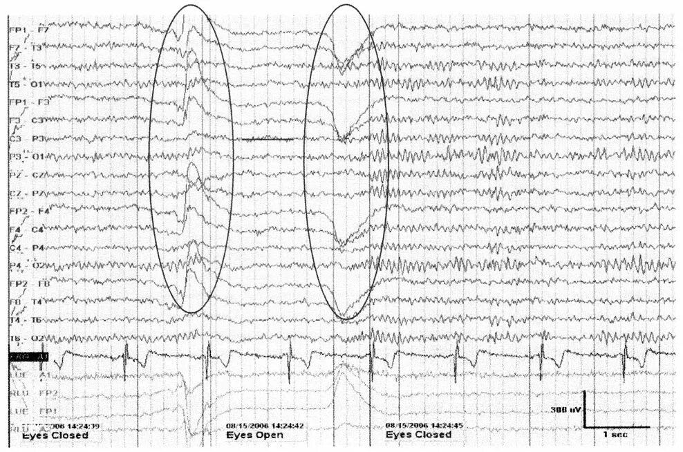 Потенциал ээг. Альфа ритм ЭЭГ. Ритм нерегулярный ЭЭГ. Альфа ритм на ЭЭГ норма. ЭЭГ индекс Альфа ритма у детей.
