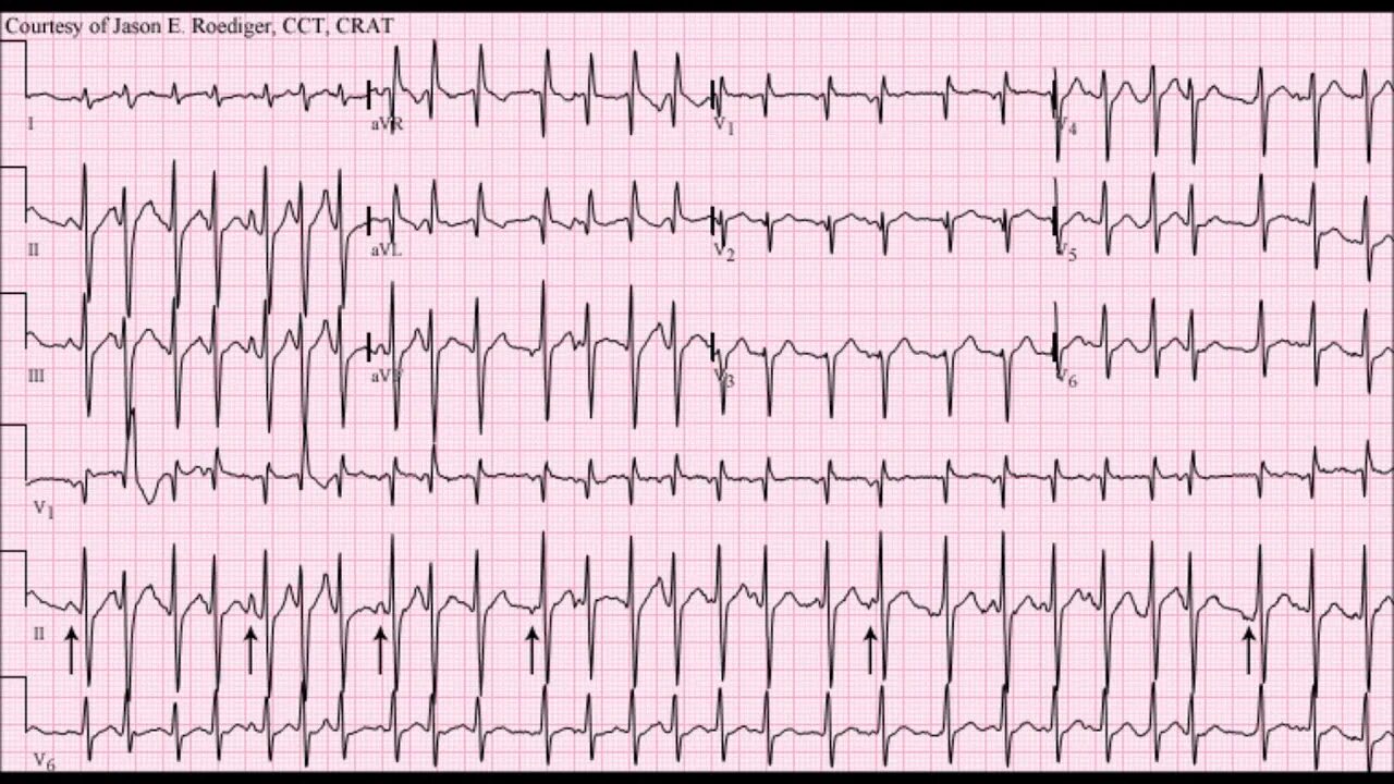 Наджелудочковые пароксизмальные тахикардии ЭКГ. Предсердная тахикардия на ЭКГ. Мультифокальная предсердная тахикардия на ЭКГ. Предсердная пароксизмальная тахикардия на ЭКГ.