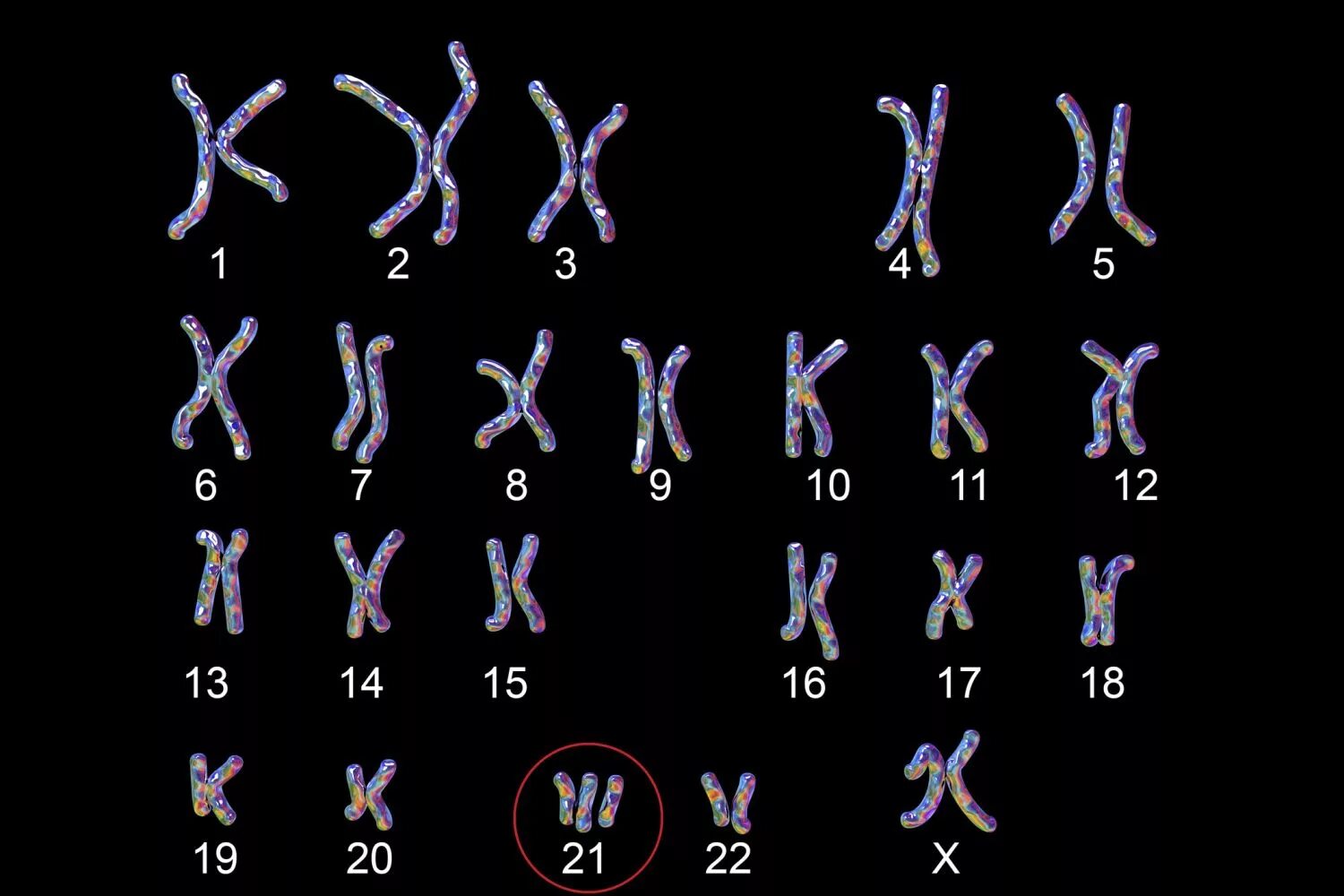 Синдром Дауна 21 хромосома. Трисомия 21 хромосомы (синдром Дауна кариотип. Синдром Дауна хромосомы кариотип. Лишняя 21 хромосома