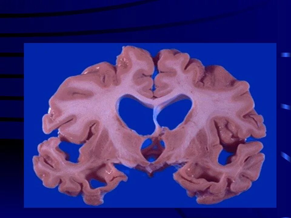 Диффузная атрофия головного мозга. Гидроцефалия патологическая анатомия. Гидроцефалия препараты патанатомия. Гидроцефалия макропрепарат. Атрофия головного мозга при гидроцефалии макропрепарат.