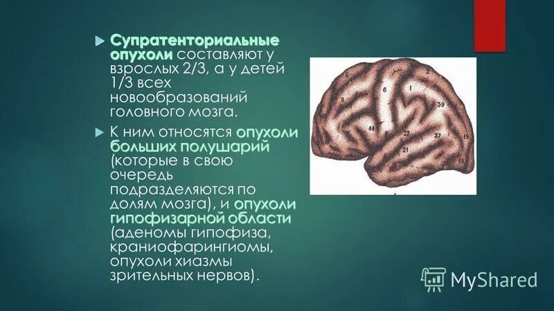 Субтенториальные структуры мозга. Надтенториальные и субтенториальные опухоли. Супратенториальные опухоли головного мозга. Субтенториальные структуры в головном мозге что это. Субтенториальная опухоль.