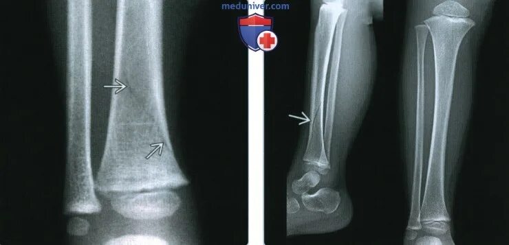 Перелом диафиза большеберцовой кости. Перелом эпифизеолиз большеберцовой кости. Перелом большеберцовой кости у ребенка рентген. Перелом диафиза большеберцовой кости спиральный.