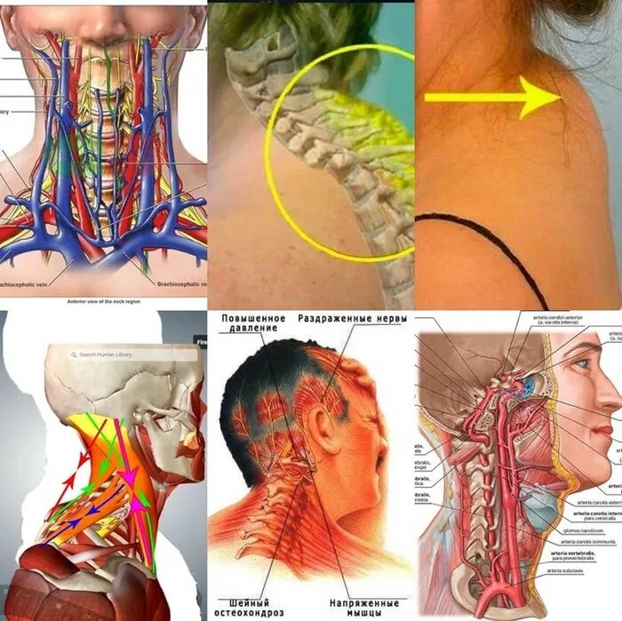 Защемило правую сторону шеи что делать. Заземления нервов в шеи. Защемление шейного нерва.