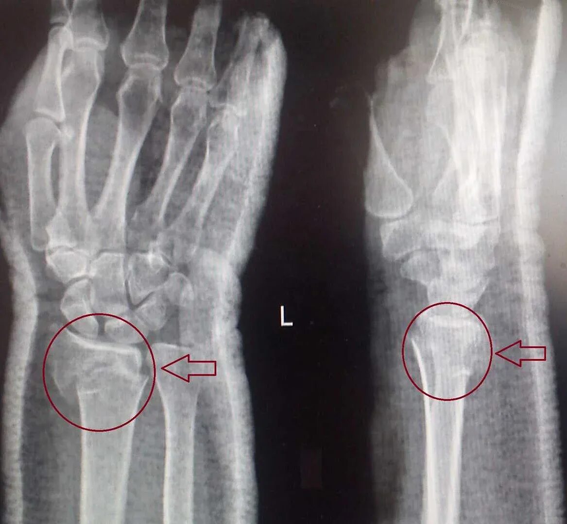 Перелом шиловидного отростка локтевой кости. Субкапитальный перелом лучевой кости. Перелом шиловидного отростка лучевой кости. Перелом лучевой кости рентгенограмма.
