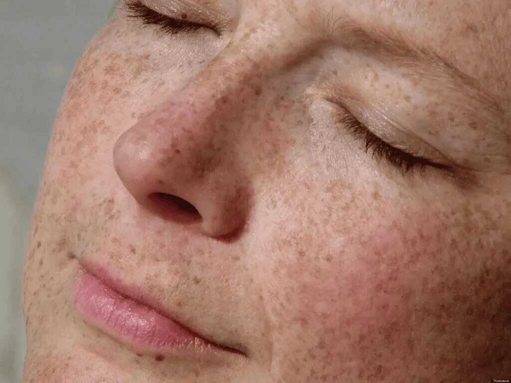 Slavens dermatologs parādīja, kā atbrīvoties no brūnajiem pleķiem uz sejas ādu a